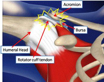 Shoulder Pain and How to Fix It Post Thumbnail