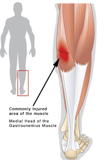Tennis Leg Post Thumbnail