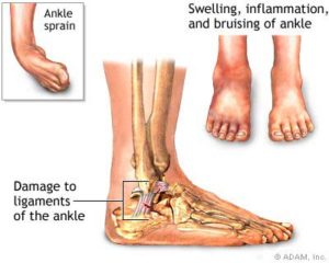 Inversion Ankle Sprain