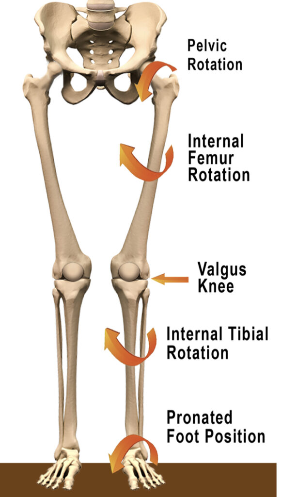 This image has an empty alt attribute; its file name is Foot-Pronation-Knee-valgus-580x1024.jpg