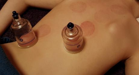 The Benefits of Cupping Therapy Post Thumbnail